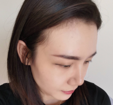 广州华美医疗美容整形医院李文锋隆鼻介绍