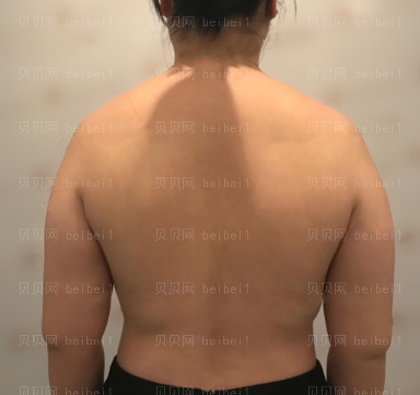 广州华美医疗美容整形医院李文锋全身吸脂介绍
