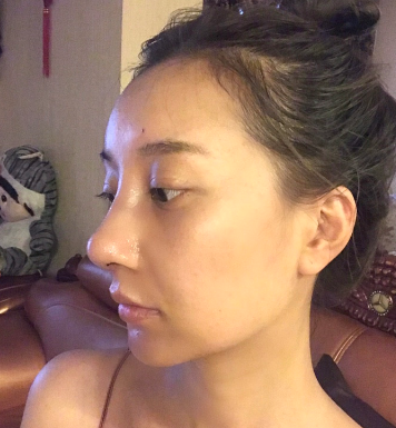 广州华美医疗美容整形医院曾高鼻部修复介绍
