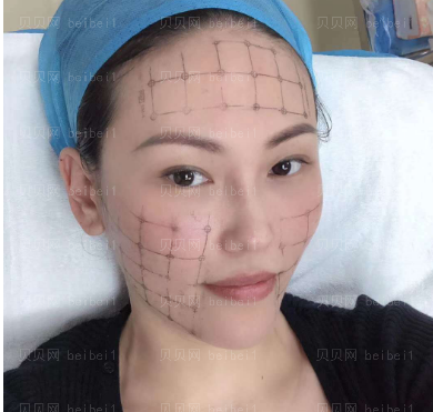广州华美医疗美容整形医院李文锋热玛吉介绍