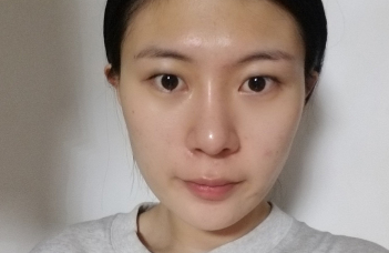 上海华美_许再荣医生_全切双眼皮+开眼角+上睑提肌_介绍分享!