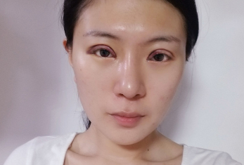 上海华美_许再荣医生_全切双眼皮+开眼角+上睑提肌_介绍分享!