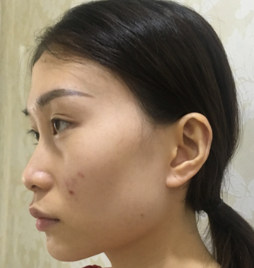 上海华美医疗美容医院李庭勋鼻部手术介绍
