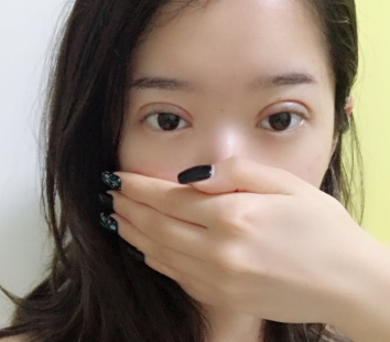 上海华美医疗美容医院佀同帅双眼皮介绍