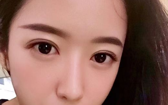 上海华美医疗美容医院佀同帅双眼皮介绍