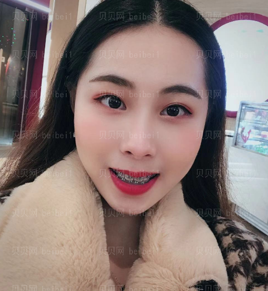 上海拜尔博尔口腔门诊逄秀凤金属托槽矫正介绍