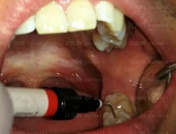 上海拜尔博尔口腔门诊孙健补牙介绍