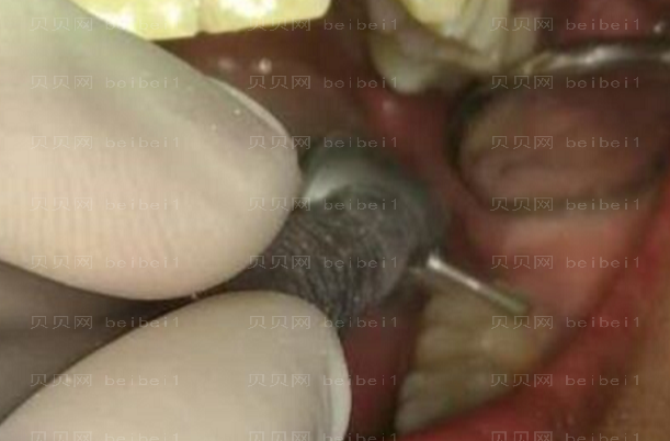 上海拜尔博尔口腔门诊孙健补牙介绍