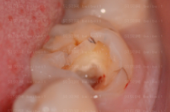 上海拜尔博尔口腔门诊孙健根管调节介绍