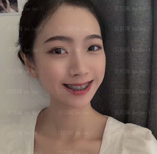 上海拜尔博尔口腔门诊杨国平金属托槽矫正介绍