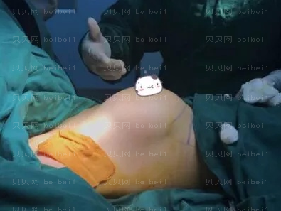 广州华美医疗美容整形医院曾高隆胸介绍