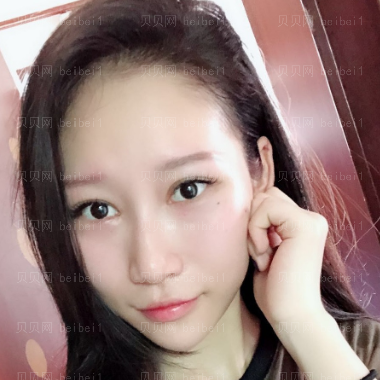 广州华美医疗美容整形医院阮庆玲去黑眼圈介绍