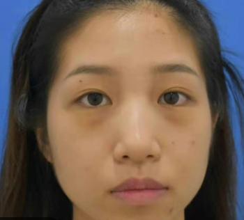 广州华美医疗美容整形医院阮庆玲祛眼袋介绍