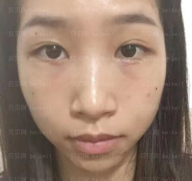广州华美医疗美容整形医院阮庆玲祛眼袋介绍