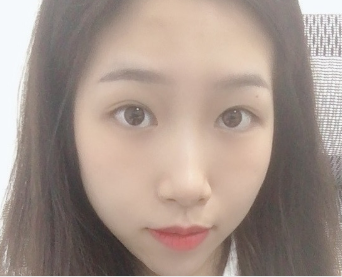 广州华美医疗美容整形医院阮庆玲祛眼袋介绍