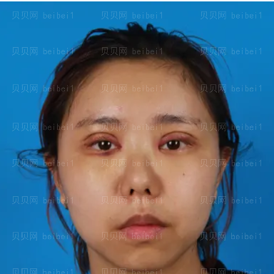 广州华美医疗美容整形医院阮庆玲双眼皮介绍
