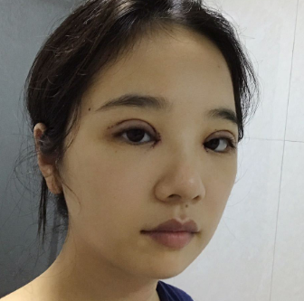广州华美医疗美容整形医院阮庆玲眼部综合介绍