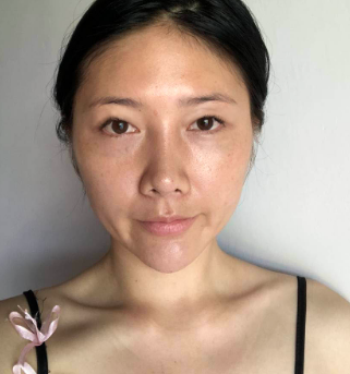 广州华美医疗美容整形医院袁耀东双眼皮介绍