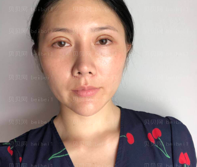 广州华美医疗美容整形医院袁耀东双眼皮介绍