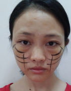 上海华美医疗美容医院程梓宁埋线提升介绍