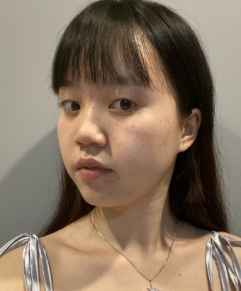 上海华美医疗美容医院姜胜勋——眼部手术+埋线提升介绍