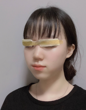 上海华美医疗美容医院姜胜勋——眼部手术+埋线提升介绍
