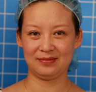 上海华美医疗美容医院刘斌-埋线提升介绍