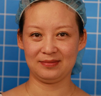 上海华美医疗美容医院刘斌-埋线提升介绍