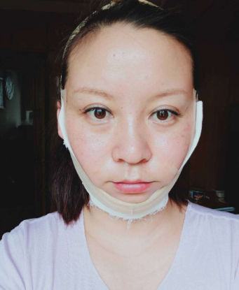 上海华美医疗美容医院刘斌-埋线提升介绍