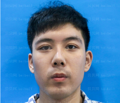 广州华美医疗美容整形医院张明兴肋骨鼻部手术介绍 