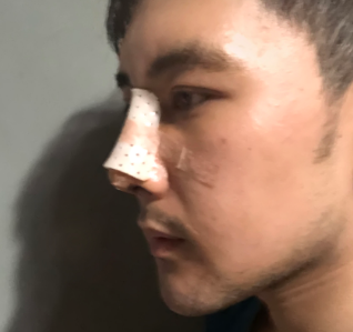 广州华美医疗美容整形医院张明兴肋骨鼻部手术介绍 