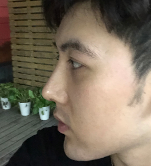 广州华美医疗美容整形医院张明兴肋骨鼻部手术介绍 