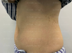上海华美医疗美容医院何斌—腰腹部吸脂介绍