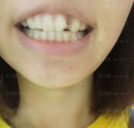 上海华美医疗美容医院黄嵩—隐形牙齿矫正介绍
