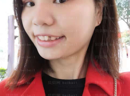 上海华美医疗美容医院黄嵩—隐形牙齿矫正案例
