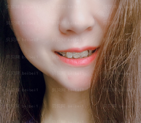 上海华美医疗美容医院黄嵩—牙齿矫正介绍