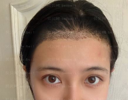 上海华美_黄兴勇医生_发际线种植_介绍分享~