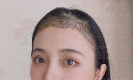 上海华美_黄兴勇医生_发际线种植_介绍分享~