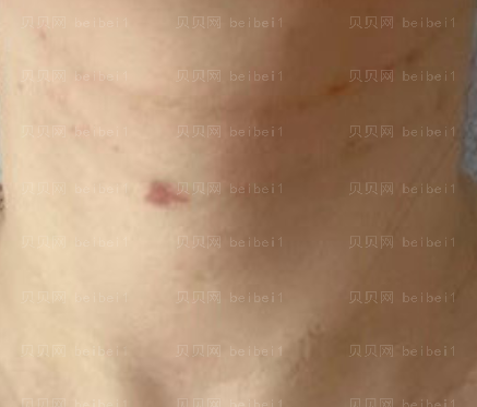 上海华美医疗美容医院杨定宇-去颈纹介绍