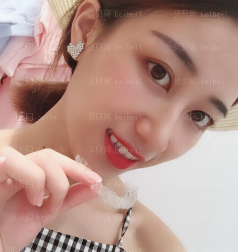 上海华美_张群医生_隐形牙齿矫正_介绍分享~