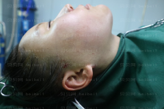 济南旭美美容医院王彪面部吸脂介绍