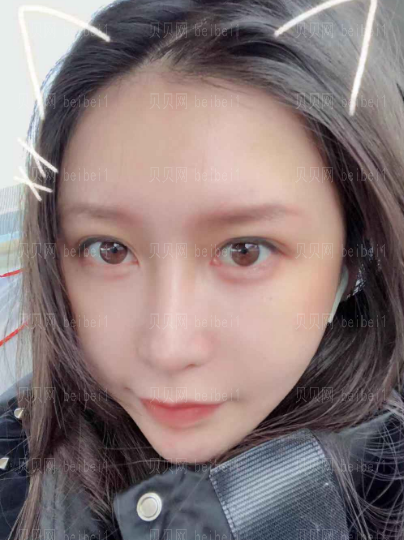 济南旭美美容医院王彪面部吸脂介绍