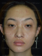 济南旭美美容医院赵子康玻尿酸去眼纹介绍