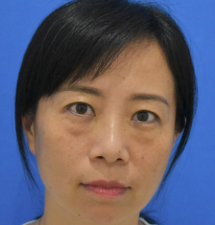 广州华美医疗美容整形医院袁耀东不开刀去眼袋介绍