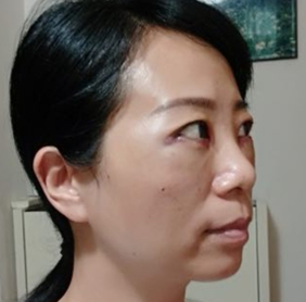 广州华美医疗美容整形医院袁耀东不开刀去眼袋介绍