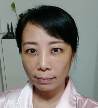 广州华美医疗美容整形医院袁耀东不开刀去眼袋介绍