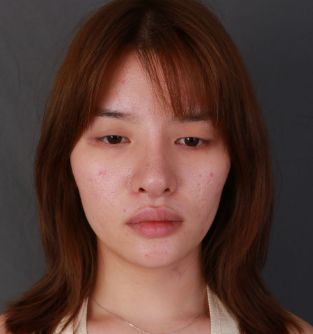 深圳博美医疗美容整形医院王红玮韩式切开眼皮介绍