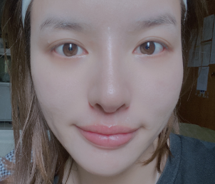 深圳博美医疗美容整形医院王红玮韩式切开眼皮介绍