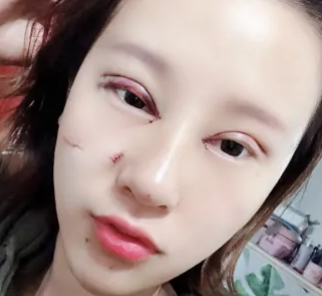 深圳爱氏整形医疗美容门诊部秦正驰双眼皮修复介绍