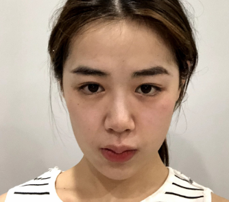 济南艺星整形医院冯雪丽 抗衰介绍